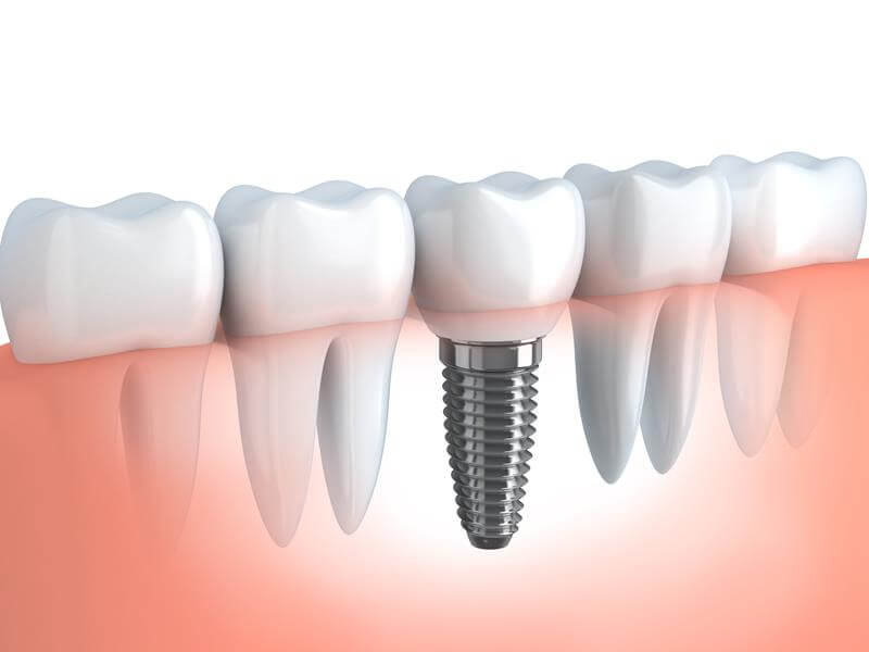 Dental Implants  Union Bridge, MD 